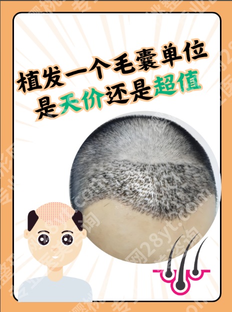 广州人民医院植发价格拆解：种2000毛囊，为啥有人花2万有人花4万？