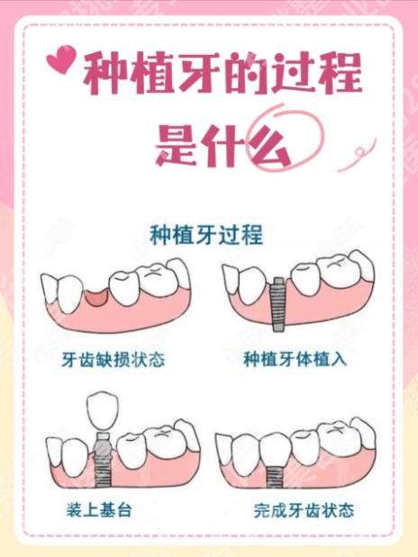 上海华东医院种植牙怎么样？2张数据表格，搞懂“种牙到底值不值”！