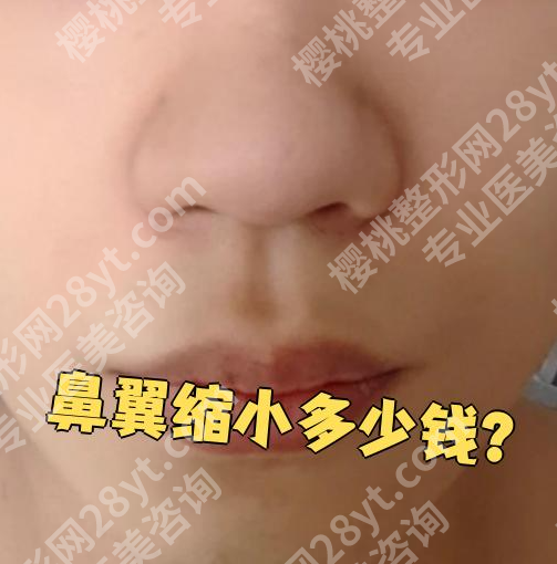 缩鼻翼手术大概要多少钱？手术方式不同，基础价差3000-8000元