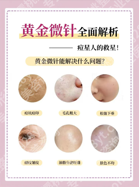 黄金微针的功效和作用：这6个皮肤问题它能解决
