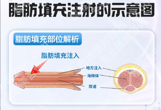 脂肪增粗后遗症全解析：这些风险要警惕，科学应对才安心