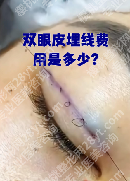 上海华山医院双眼皮埋线费用大揭秘！从3800到8000，差在哪？