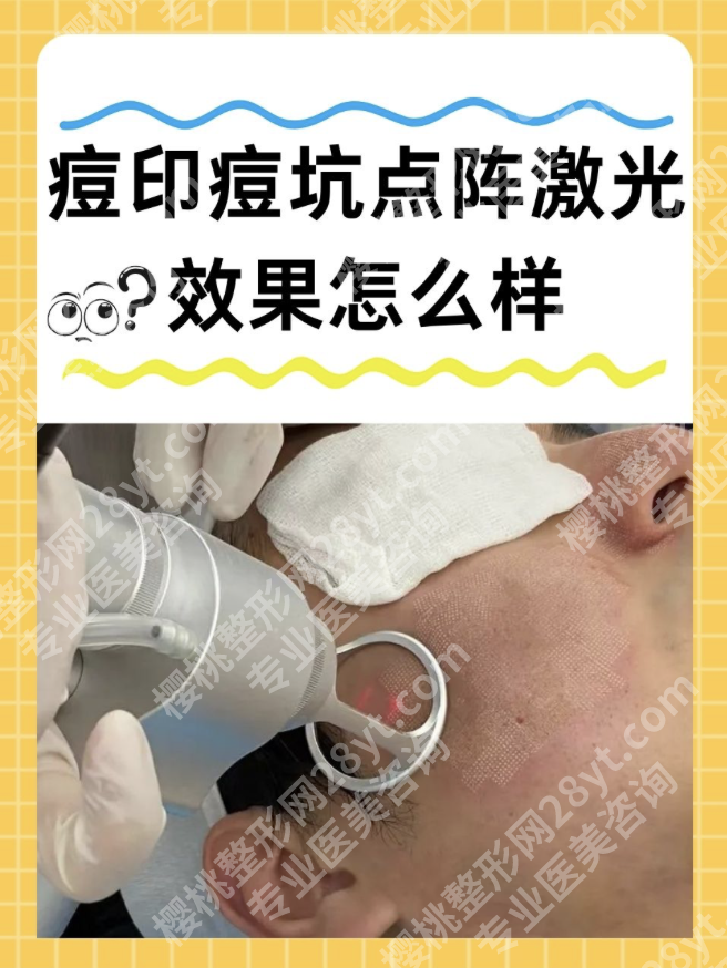 南方医院激光祛痘印：分型方案，不同痘印的精准打击策略