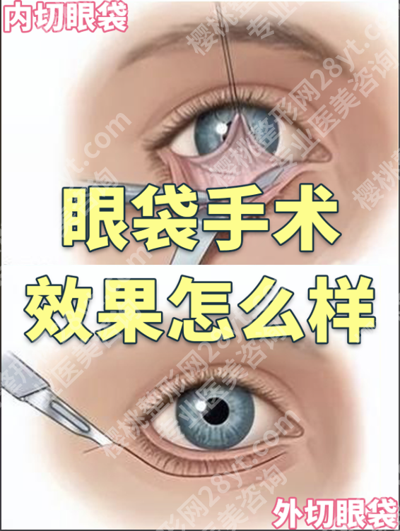 上海东方医院祛眼袋怎么样?0.1mm精准操作+98%满意度实测