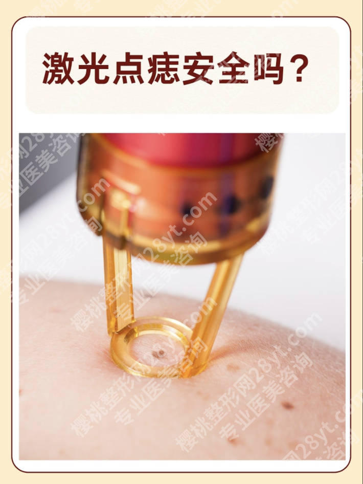 安徽省立医院激光祛痣多少钱？2025年真实价格表+3类痣案例实测
