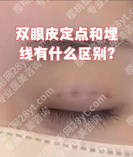 定点双眼皮和埋线哪个恢复快？核心对比，一篇讲清不踩坑