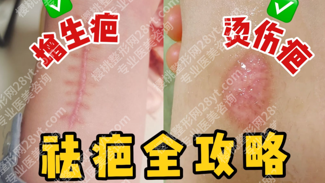 上海第十人民医院去疤痕多少钱？核心花在3个地方！