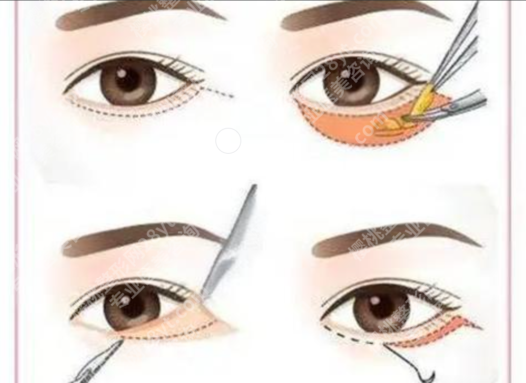 厦门第一医院割眼袋价格：3种眼袋类型，对应3种价格方案