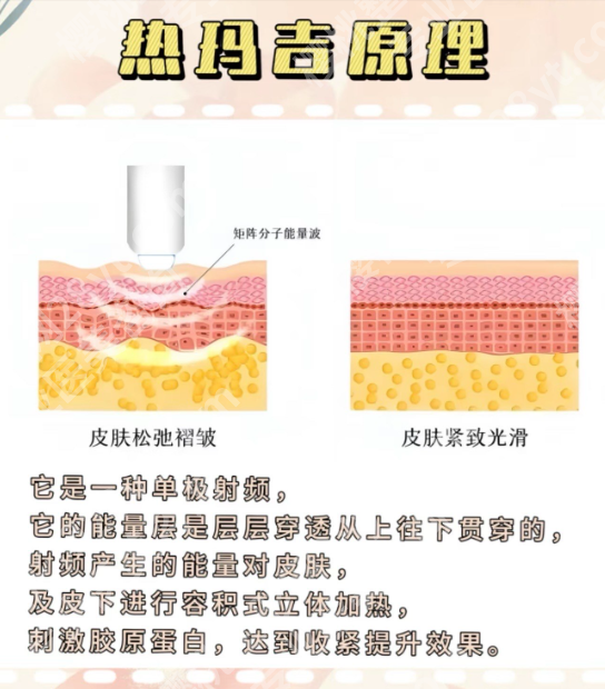热玛吉的工作原理：不是“加热皮肤”这么简单！3篇论文揭示核心原理