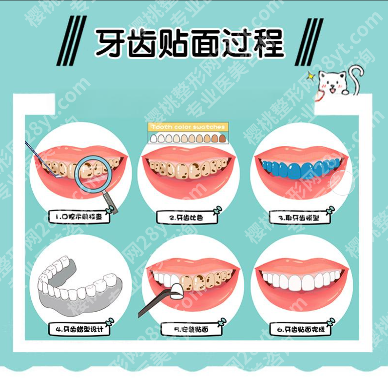 牙贴面是怎么贴上去的？一篇看懂牙齿美容的全过程