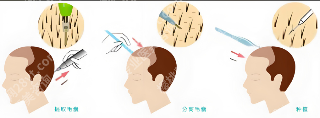 杭州第一人民医院植发挂什么科？2025年挂号攻略+真实费用曝光
