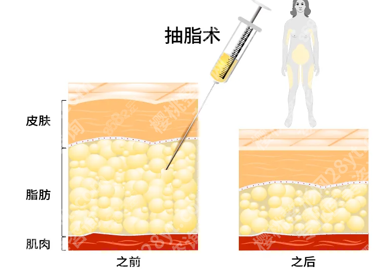 深圳北大抽脂多少钱？这3个细节能省时间省钱