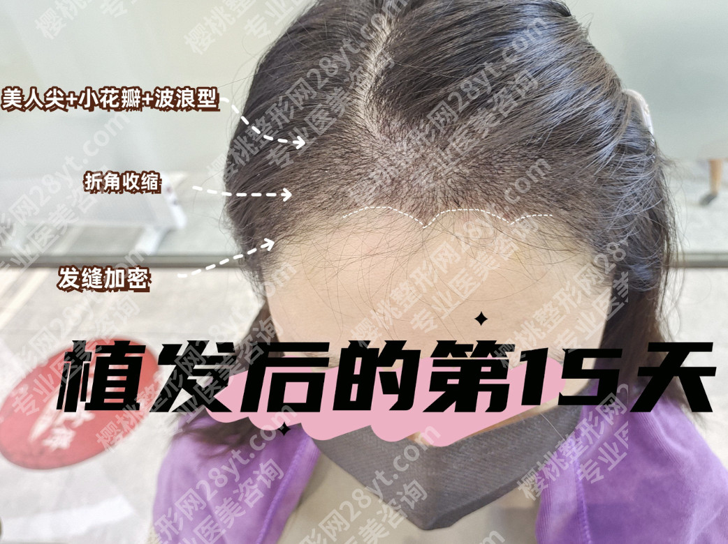 北京大学第一医院植发怎么样？百年科室的植发黑科技