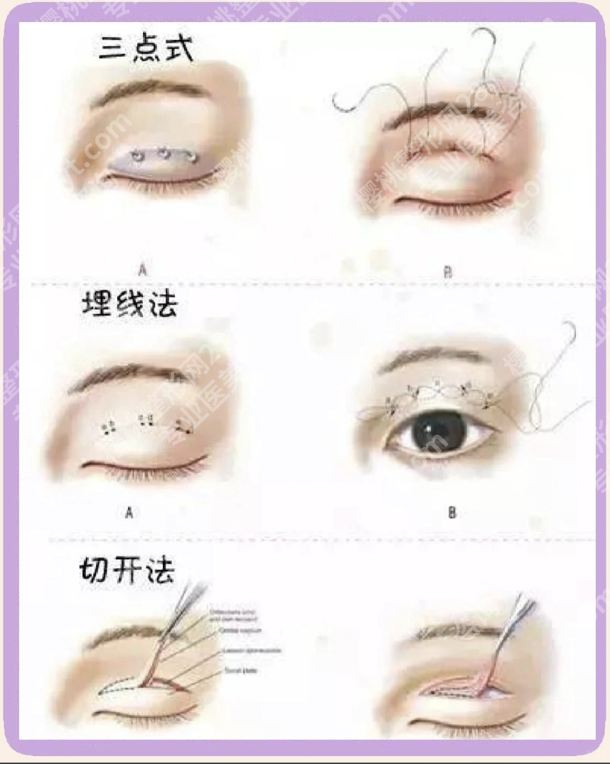 北京医院双眼皮手术：数据告诉你如何避免踩坑