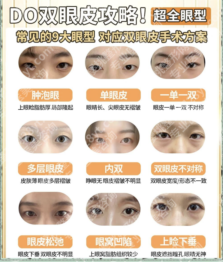 中山三院双眼皮手术全攻略：2025年医生推荐+术式对比+真实案例