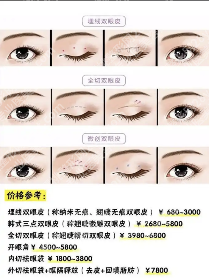 北京301医院割双眼皮价格：2025年新术式报价+真实案例参考