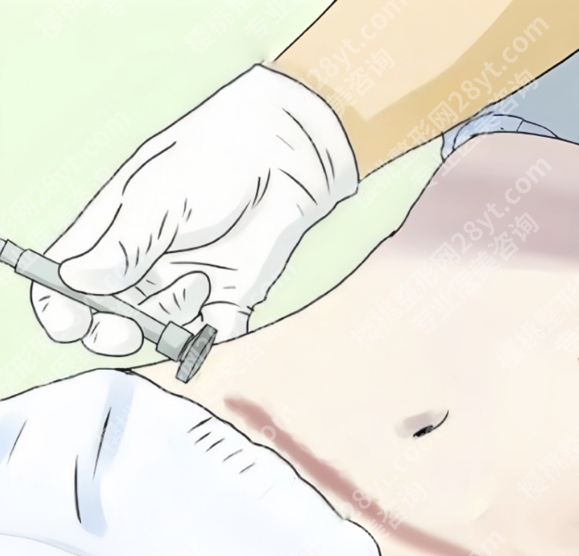 武汉腹壁整形术好的医院看这里：手术难度“天花板”，涉及4层组织修复