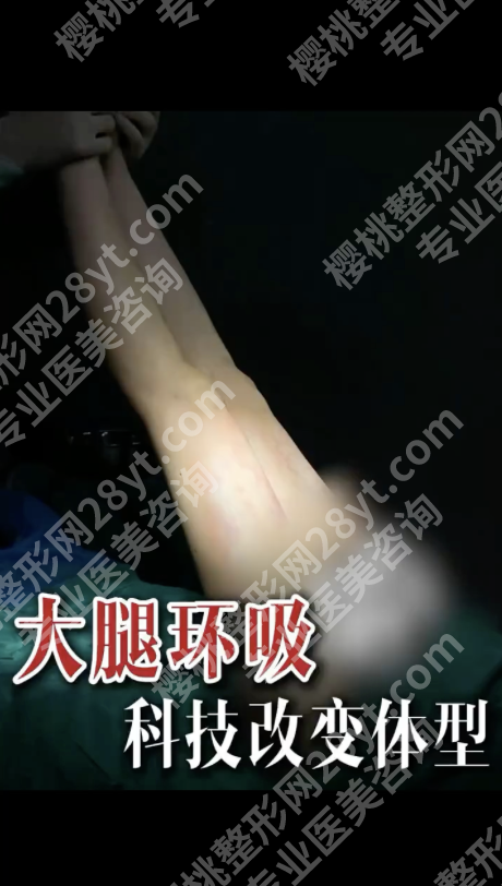 长沙做大腿环吸哪个医生好？3位名医+选医指南，闭眼抄作业！