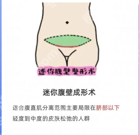 长沙腹壁整形多少钱？价目表曝光，不同方案差2万！