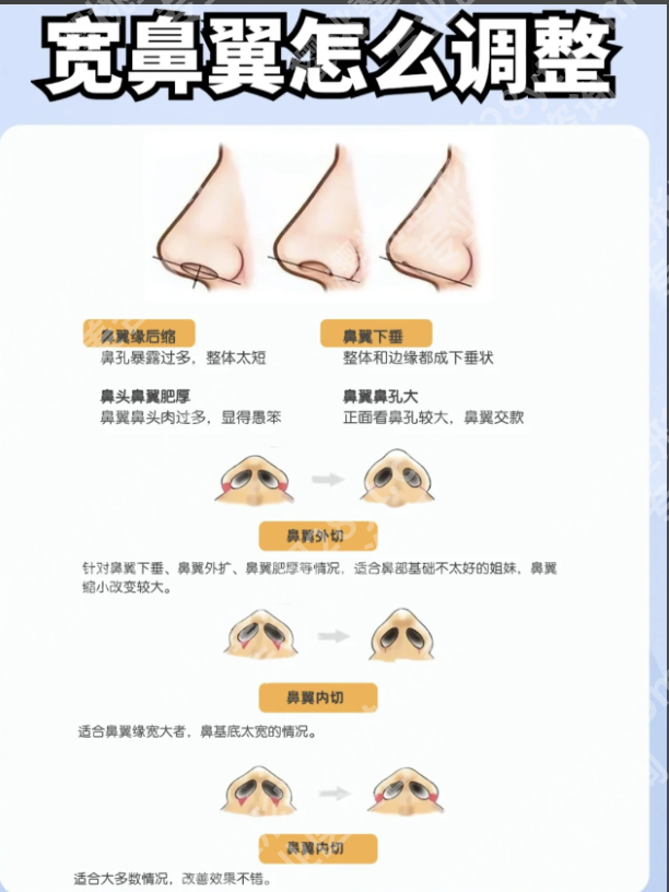 鼻翼宽大怎么？3类方案帮你缩出精致小翘鼻