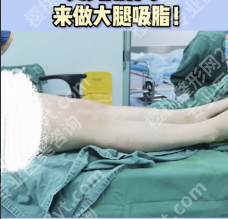 南京腿部吸脂手术大概多少钱?哪家好?