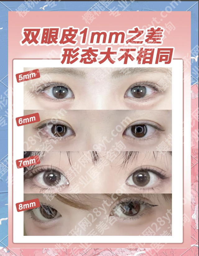 华西医院张振宇双眼皮怎么收费？深扒费用构成（附明细表）