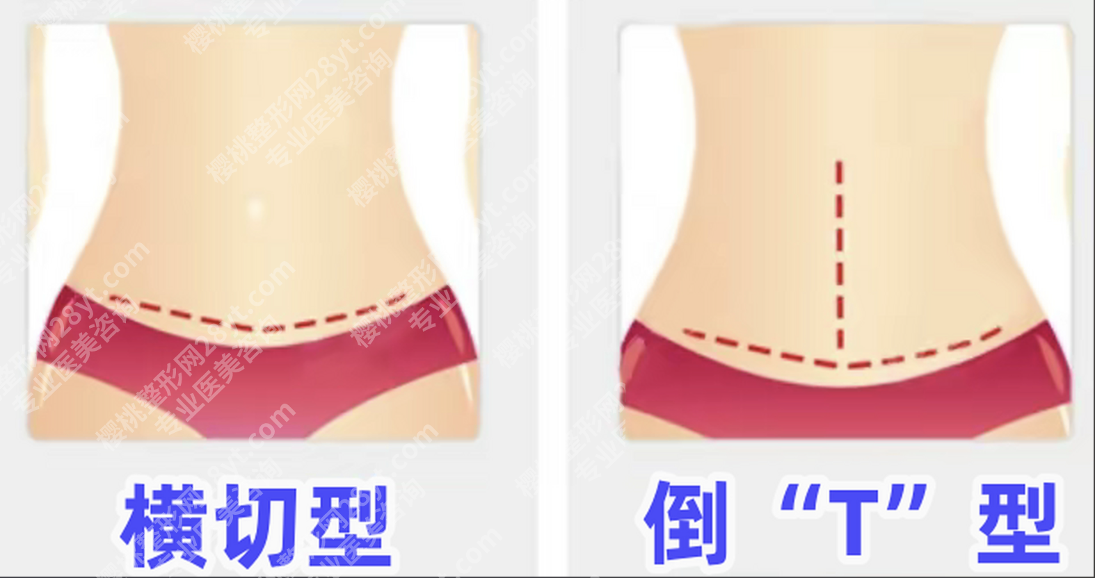 广州腹壁整形好的医院：实测6家，这4家+5位医生能闭眼冲
