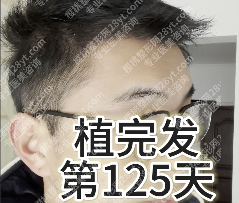 台州哪里种植头发医院好？不看排名看“对症”，5家机构+3类案例