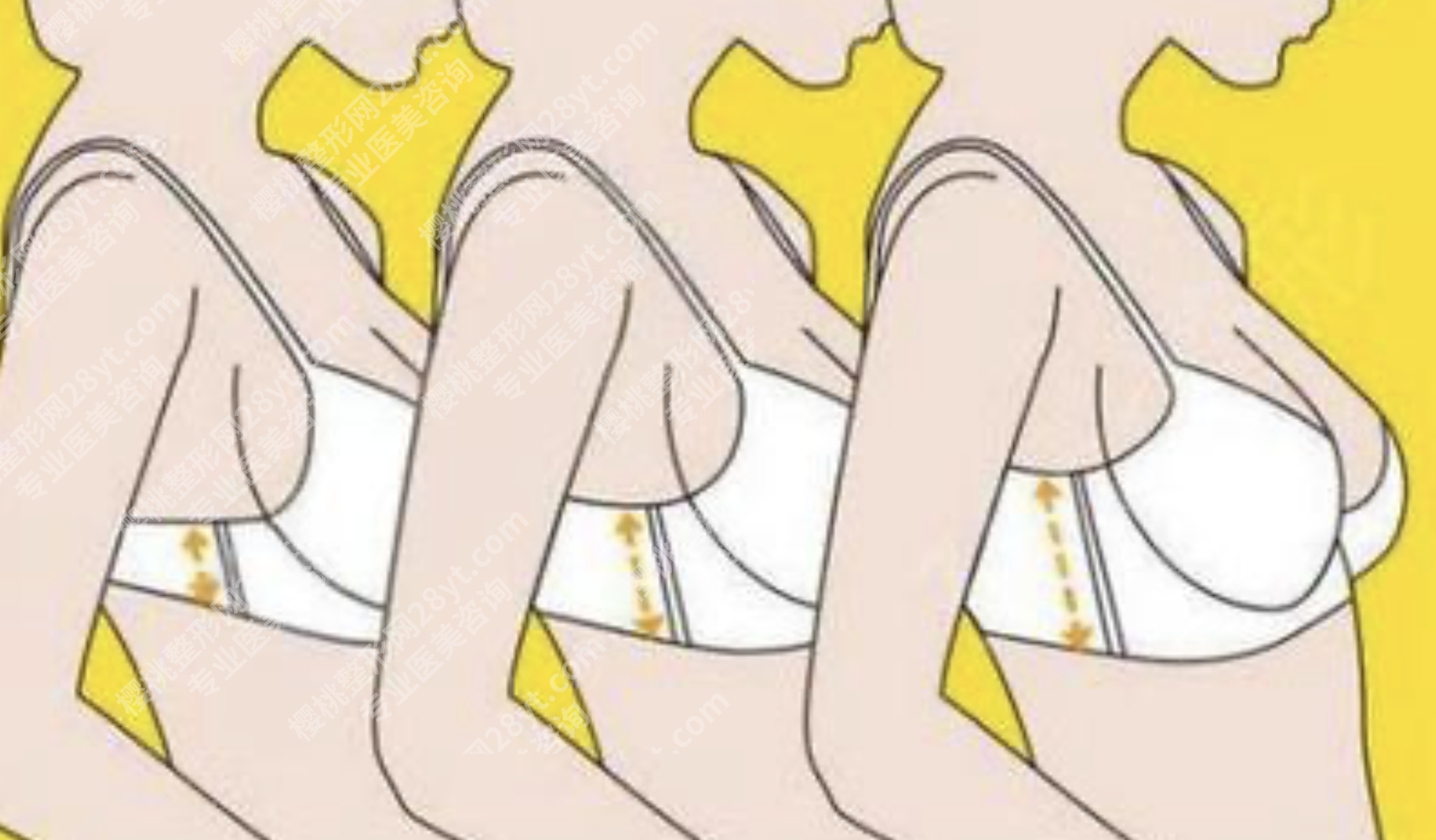 杭州第二人民医院隆胸怎么样？3种胸部问题，在市二医院这样变美