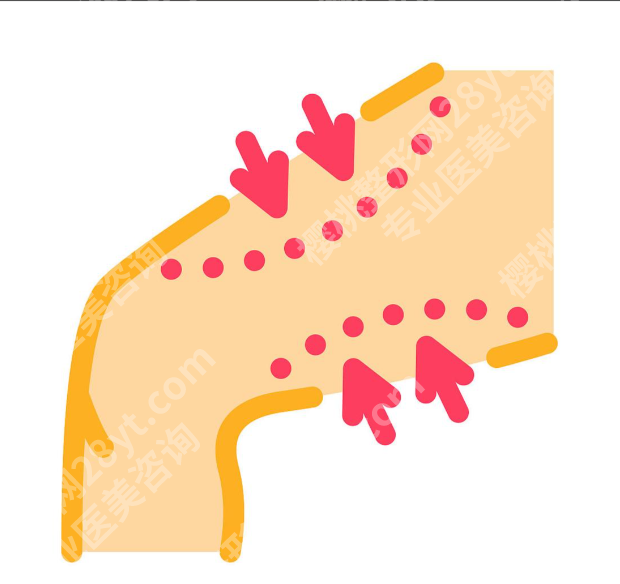 深圳大腿吸脂的价格2025参考+医院排名：选对机构少走弯路