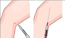杭州大腿吸脂好医生是谁？这几位您可千万要记牢喽