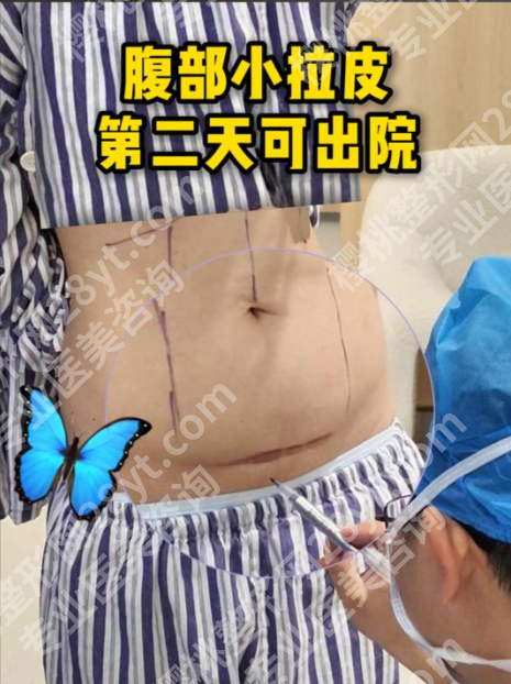 武汉腹部拉皮手术需要多少钱？哪家好？