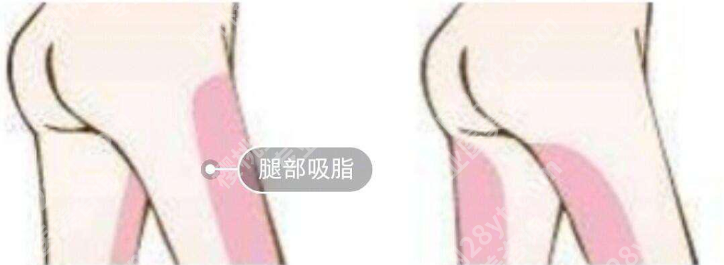 北京大腿吸脂要多少钱？不同医院大腿吸脂价格案例分析