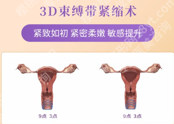 束带紧缩术效果怎么样?从临床数据、实际案例和术后护理深入聊聊