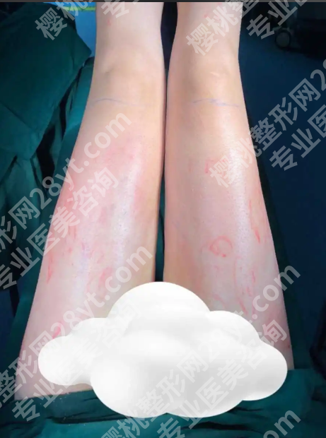长沙大腿吸脂哪家便宜？真实低价机构测评+避坑指南，钱花对才叫值
