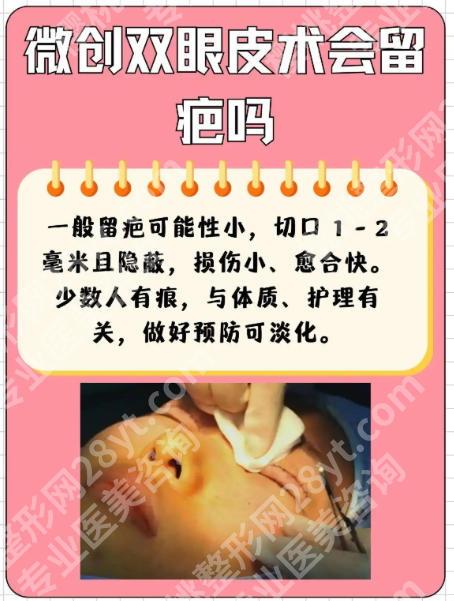 做微创双眼皮有什么危害？两张表格帮你看清风险与安全