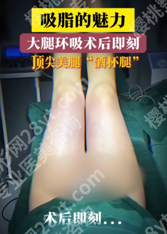 杭州大腿吸脂手术医院：术式是关键，3种腿型对应3种方案