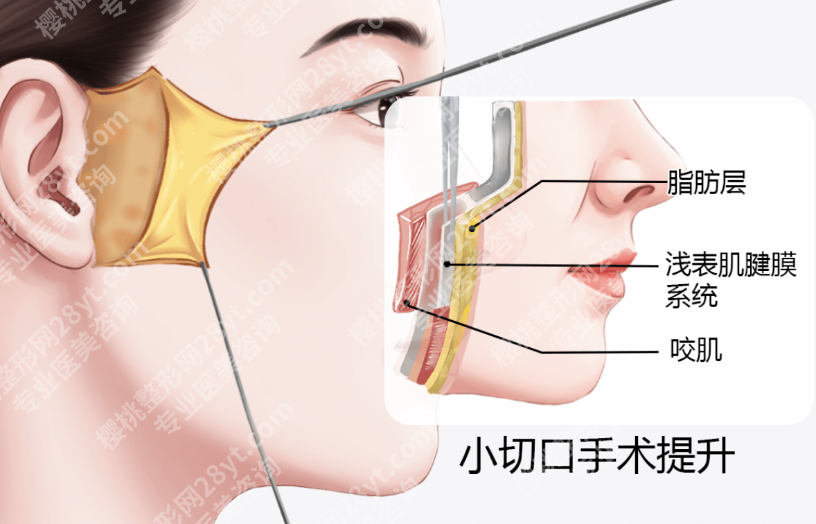 南京医院可以做小拉皮手术吗?3家靠谱机构+2张表,下颌线/法令纹修复全实测