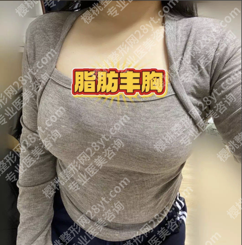 杭州自体脂肪丰胸三甲医院选哪家？3家特色机构+真实案例（附技术亮点）