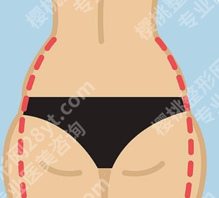 妈妈臀抽脂和大腿哪个疼？附真实痛感测评来了
