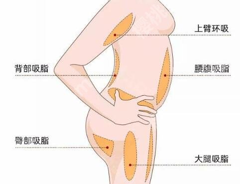 水动力吸脂的切口大小怎么样？怕留疤的姐妹，看完这篇不用慌