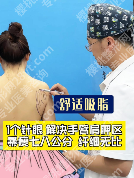 肩胛骨吸脂多少钱？价格从5k到 3w，差在哪？