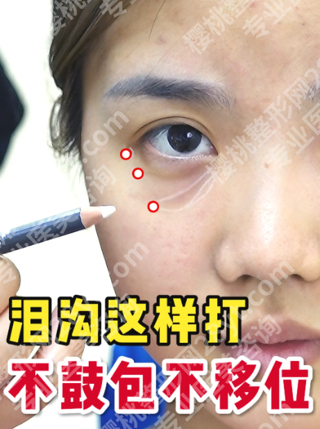 玻尿酸填充泪沟怎么样？3类人群实测+避坑指南，看完再决定