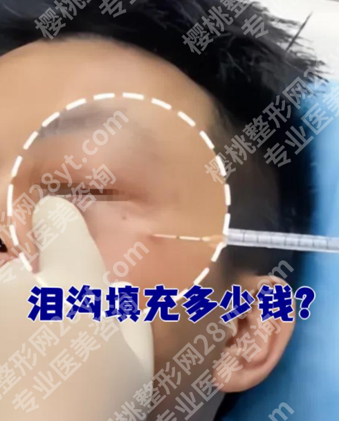玻尿酸填充泪沟多少钱？两张表看透价格与选择，不花冤枉钱