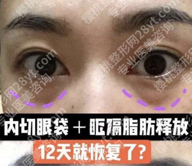 哈尔滨瑞丽做眼袋如何?技术/医生/案例全揭秘,2025避坑指南