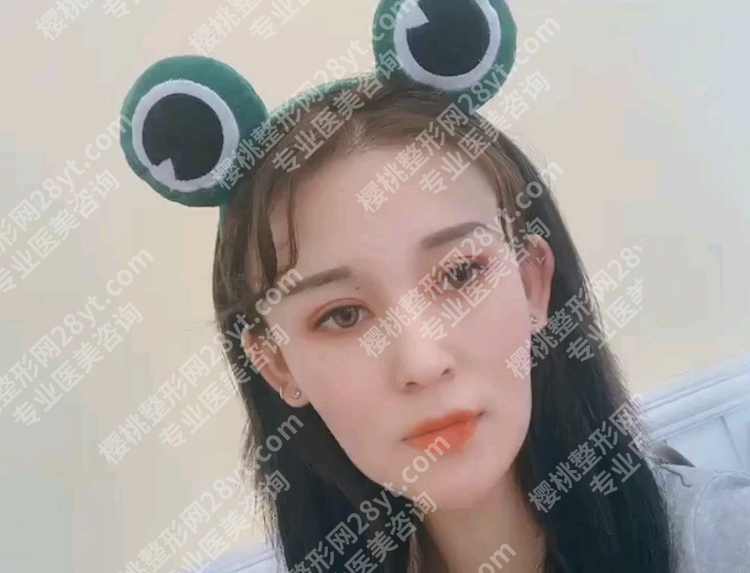 哈尔滨瑞丽做双眼皮怎么样?10年老牌+眼修复王牌,3个真实案例扒透靠谱度