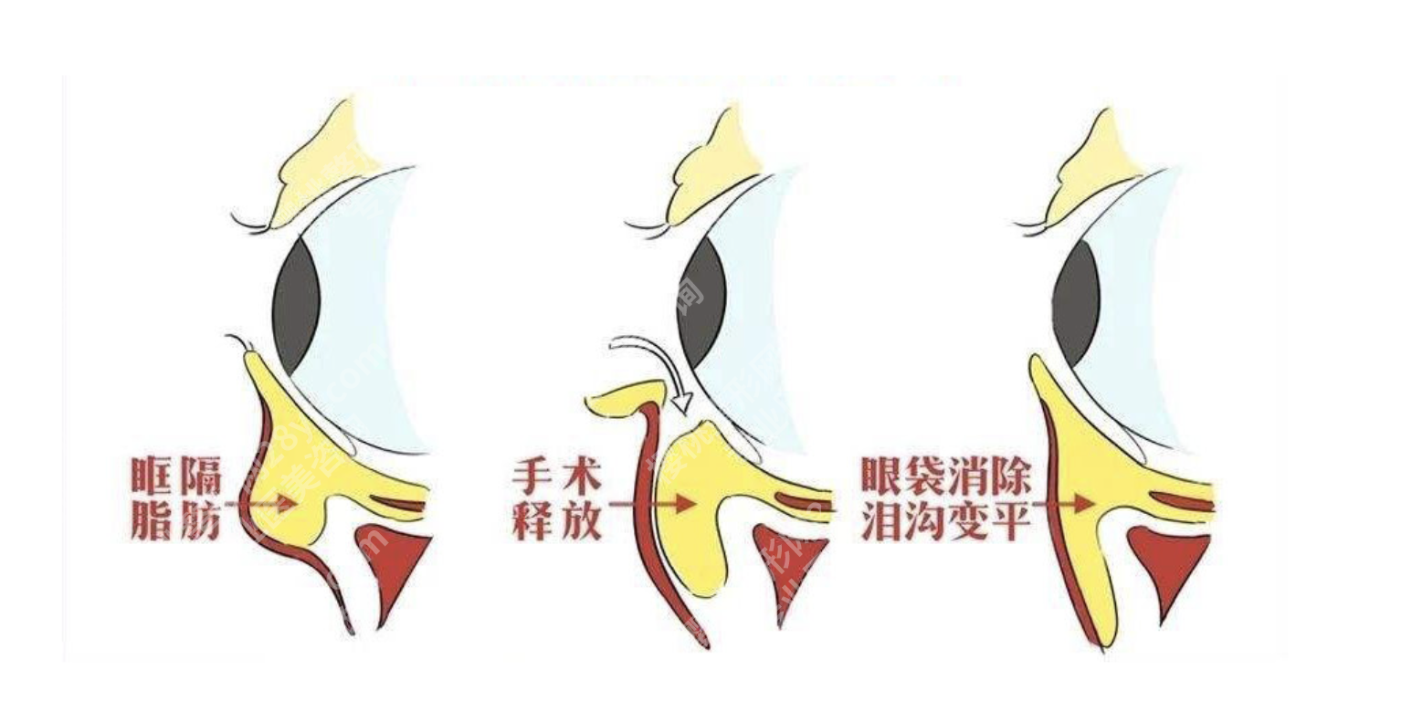 眶隔脂肪释放术多久能恢复?28天时间表+3个真人案例,上班党也能轻松抗衰