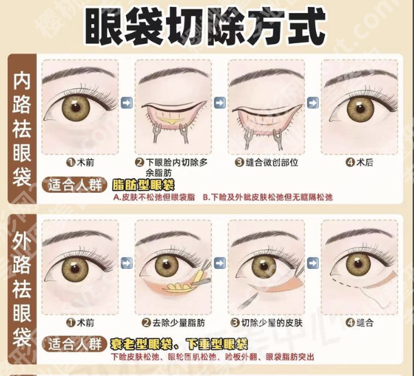 内路祛眼袋和外路祛眼袋的区别:2张表分清差异!3个真实案例教你选对不踩雷
