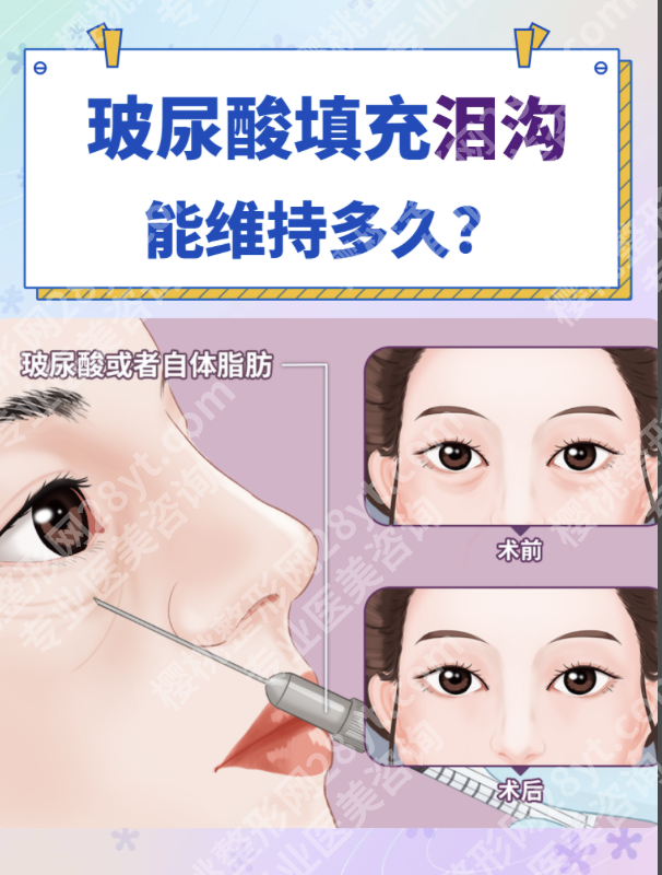 玻尿酸填充泪沟能管多久?3组真人案例+2份数据,揭秘维持时长真相