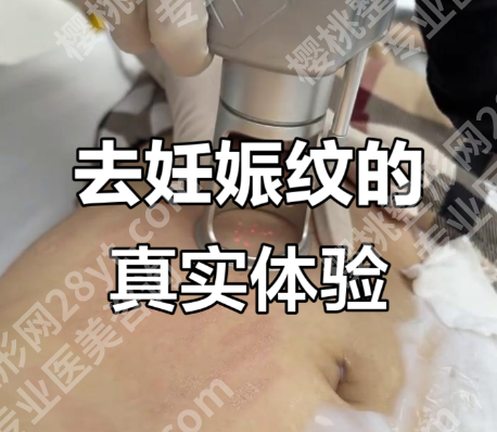 妊娠纹能修复吗?哪家医院正规?3个案例+数据给答案